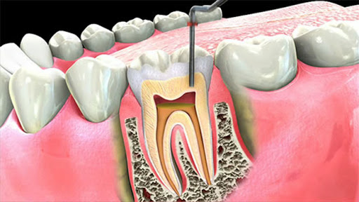 root canal treatment in mansarovar jaipur